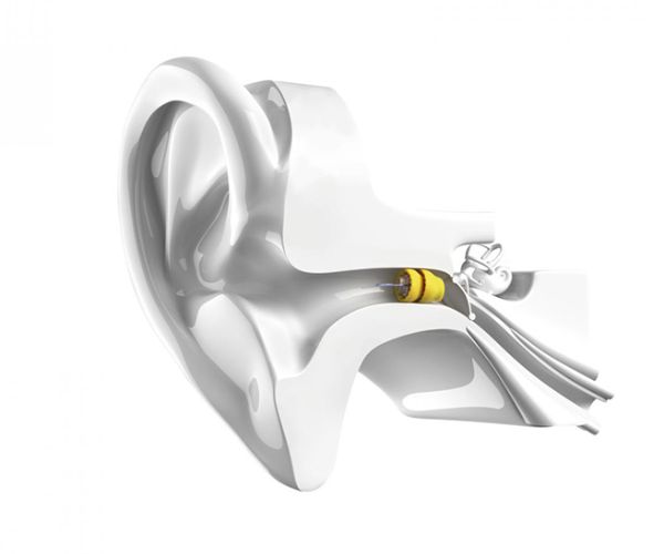 Audioprothésiste Béziers