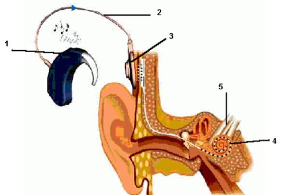 Audioprothésiste Béziers